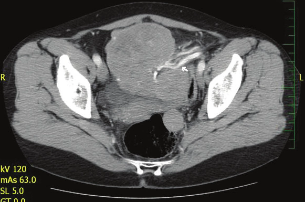 CT břicha s nálezem expanze v dutině břišní s cévním zásobením z a. et v. lienalis
Fig. 1: CT of the abdomen with a finding of expansion in the abdominal cavity with vascular supply from the splenic artery and vein
