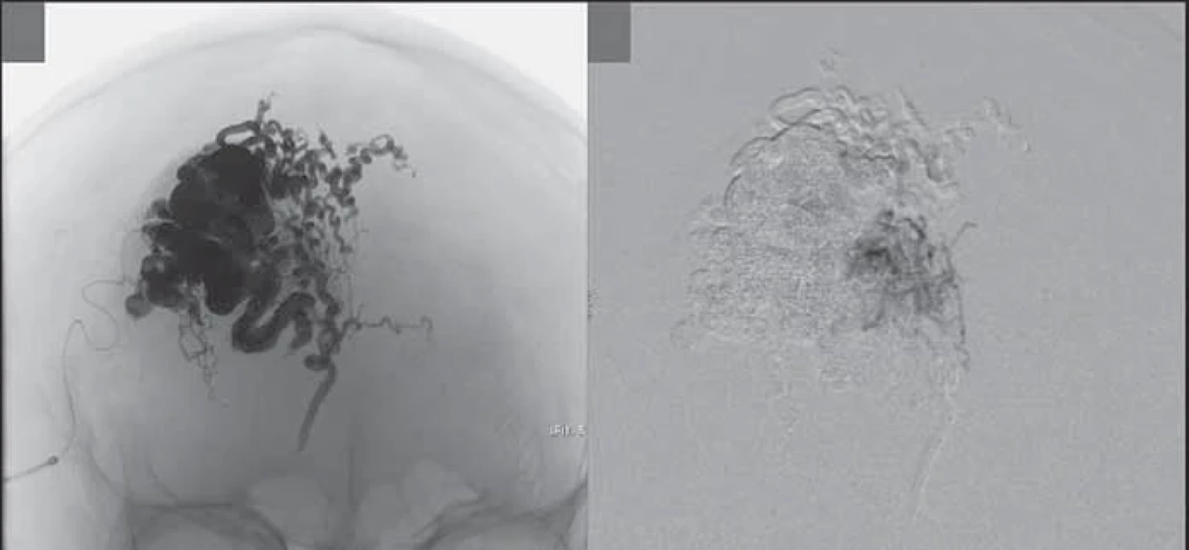 Figure showing angiographic appearance before (A) and after embolization (B).