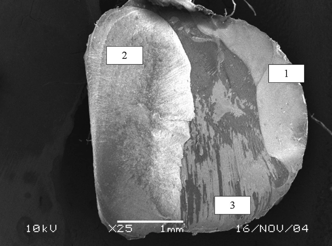 Typický charakter smíšeného lomu zasahujícího do kompozitu (1), dentinu (2) a vrstvy adheziva či hybridní vrstvy (3). Pohled ze strany kompozitního materiálu, adhezivum Gluma Comfort Bond, zvětšeno 25x.