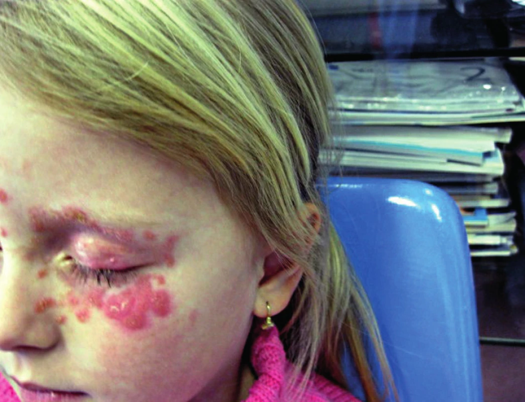 Tinea faciei vyvolaná <i>A. benhamiae</i>