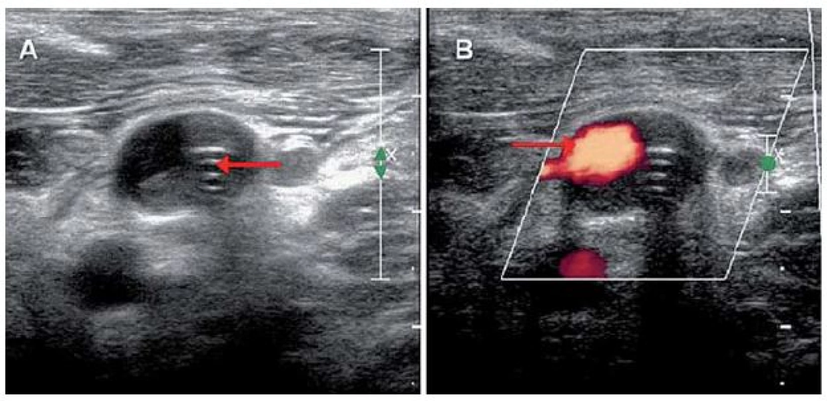 Ultrasonografie, příčná projekce.