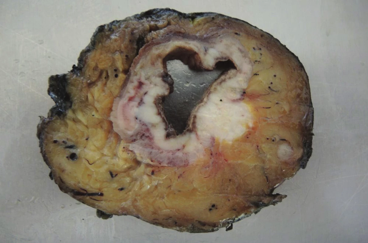 Příčná lamela resekátu v místě nádoru
Fig. 4: Transverse lamella of the resection specimen at the tumour site