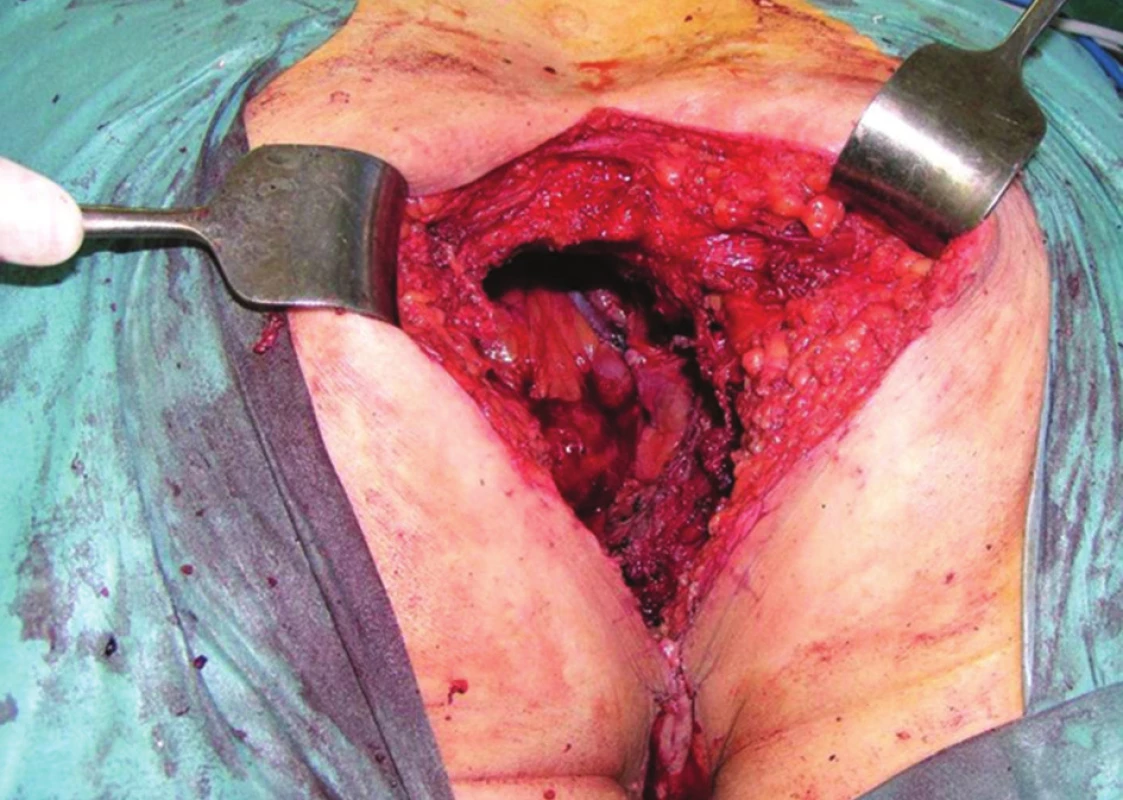 Operační nález, poloha nemocného na břiše: stav po kompozitní pelvické exenteraci s resekcí os sacrum
Fig. 7: Surgical finding, patient in the jackknife position: status after composite pelvic exenteration with sacral bone resection