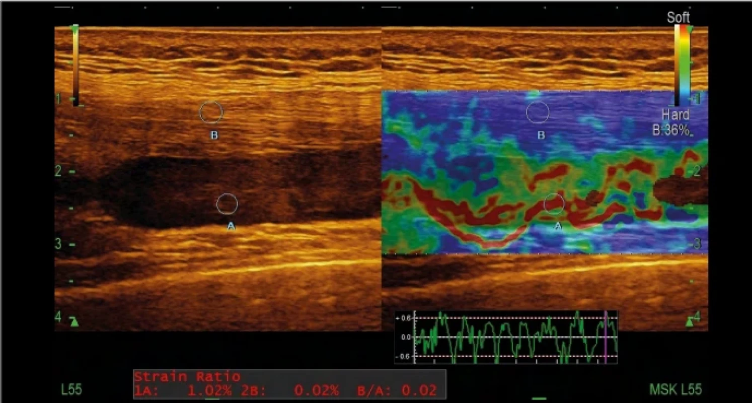 Vzorový echografický synovialogram stadium tertium. Obraz elastografického vyšetrenia 2B mod recessus suprapatellaris pri haemarthros kolena, softwarové meranie strain ratio, kvantitatívny echografický synovialogram štádium gama-γ. Sonda v dlhej osi končatiny – suprapatelárny recessus. Vizualizácia: tekutinová kolekcia zmiešanej echogenity a elastografia, tieň bázy pately, prefemorálne a suprapatelárne tukové teleso, tendo m. quadriceps. Fig. 4. Sample of an echosynovialgram grade III. 2B mode ultrasound image of the suprapatellar recess of a knee hemarthrosis. Strain ratio measurement; quantitative echosynovialgram grade gamma-γ. Long axis view of the suprapatellar recess: collection with heterogeneous echogenicity with elastography, shadow of the base of the patella, prefemoral fat pad, suprapatellar fat pad, and quadriceps tendon. 