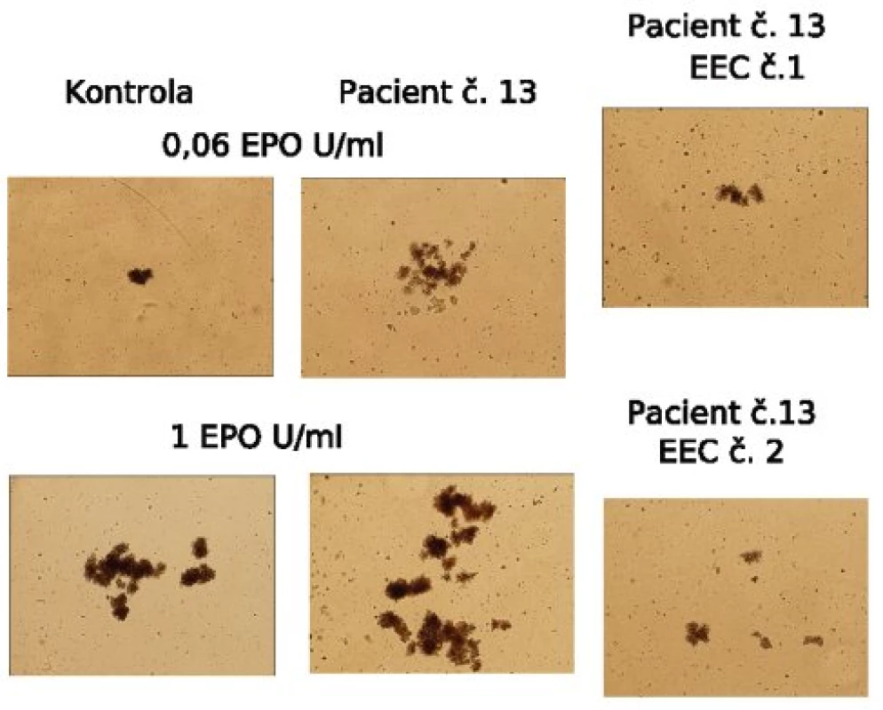 Hematopoetické kolonie, hypersenzitivita na erytropoetin (Epo). Fotografie erytroidních kolonií (BFU-E) získané 14. den kultury. EEC: endogenní erytroidní kolonie, tj. kolonie rostoucí i bez přidání exogenního Epo. Je patrný výrazný rozdíl mezi růstem kolonií (počtem i velikostí) kolonií u pacienta č. 13 a kontroly.