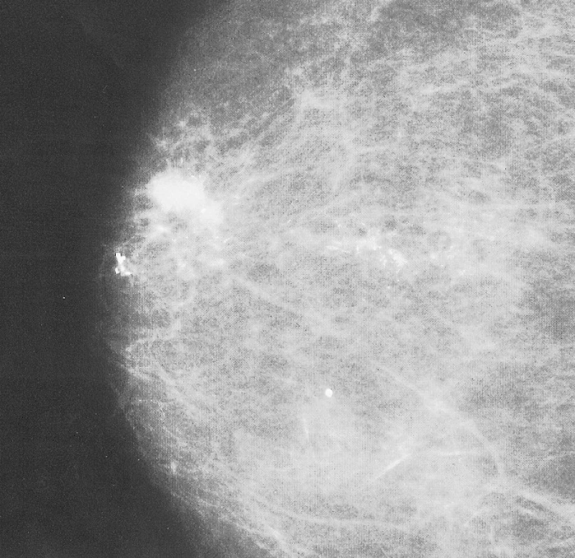 Mammogram pravého prsu: maligní léze s mikrokalcifikacemi
a satelitním ložiskem