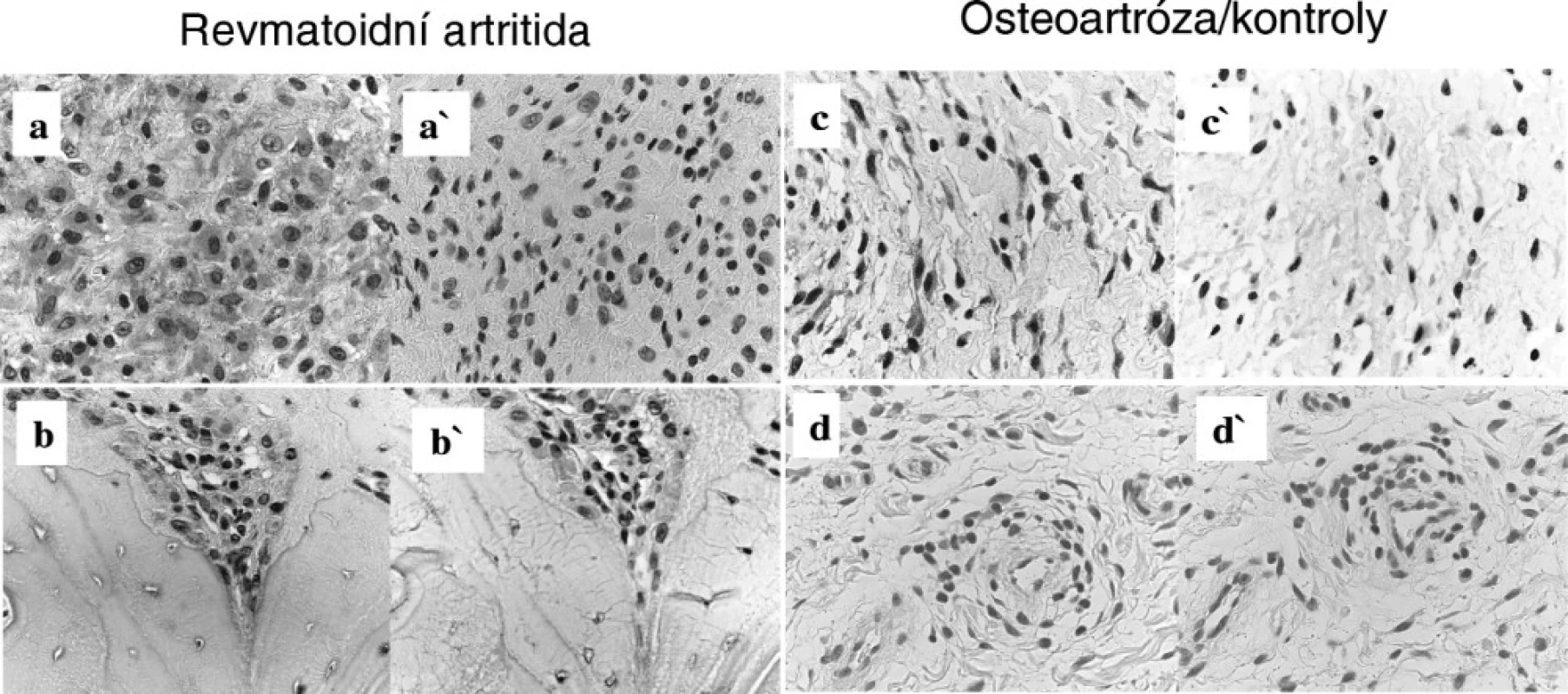 Imunohistochemie proteinu S100A4 v synoviální tkáni u pacienta s revmatoidní artritidou – oblast synoviální intimy a intersticia (A), destrukce kosti (B), dále u pacienta s osteoartrózou – oblast synoviálního intersticia (C) a u kontrolního jedince s poúrazovou etiologií (D). Jako negativní kontrola byl použit myší imunoglobulin (Ig) G (a´, b´, c´, d´). Originální zvětšení 400x.