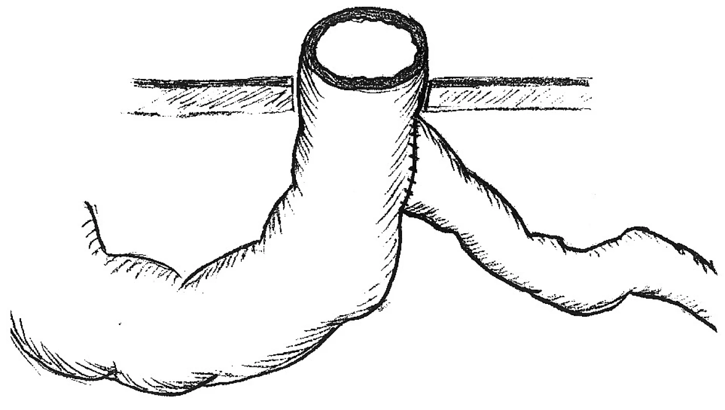 Santulli-Blancova Roux Y anastomóza. Stomovaný je široký orálny segment
Fig. 6. The Santulli-Blanc Roux Y anastomosis. The stoma procedure is performed on the wide oral segment