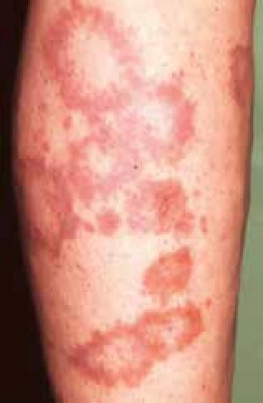 Granuloma anulare – diseminovaná forma
ochorenia u pacienta s DM