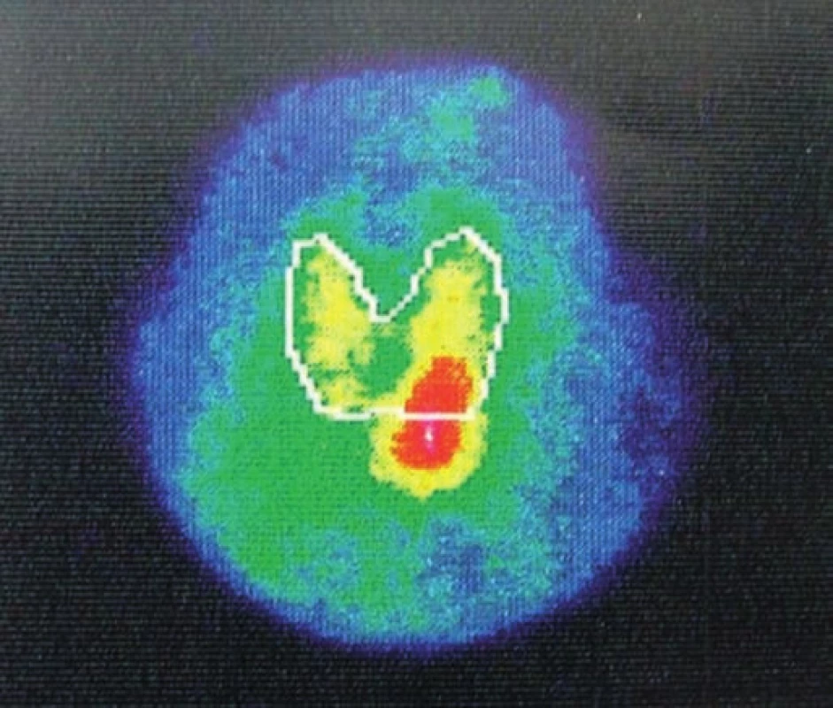 Scintigrafia štítnej žľazy a prištítnych teliesok – hypoechogénne ložisko pod dolným pólom ľavého laloka štítnej žľazy. 
Fig. 4. Nuclear scan of the thyroid and parathyroid glands – a hypoechogenic structure at the lower pole of the left lobe of thyroid gland.