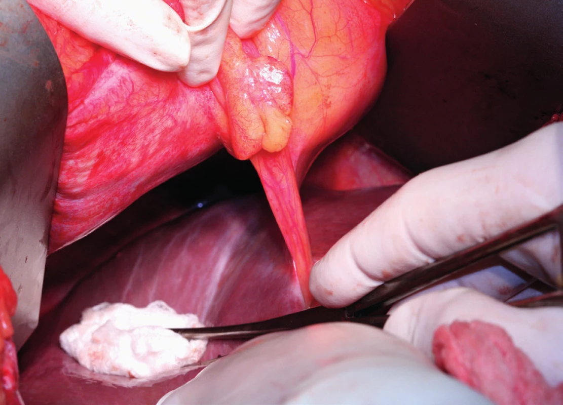 Ligamentum falciforme hepatis