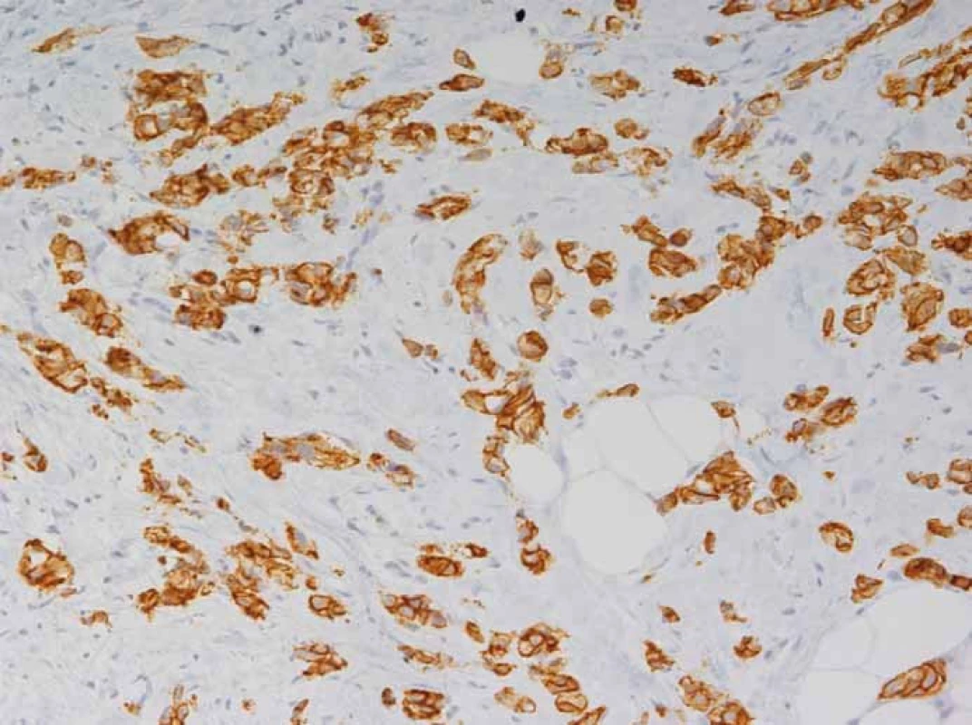 V imunohistochemickém průkazu je zřejmá vysoká oeverxprese HER2 (3+).