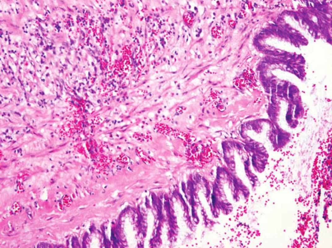 Dysplazie vysokého stupně v epitelu vystýlajícím lumen appendixu (HE, 120x)
Fig. 3. Severe dysplasia of the epithelium lining the appendiceal lumen (HE, 120x)
