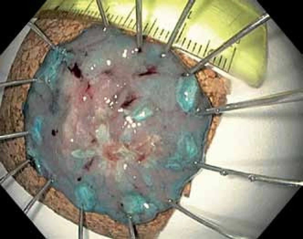 Metoda ESD: resekát 34 × 33 mm napnutý na korkové podložce. Histologicky intramukózní adenokarcinom. R0 kurativní resekce.