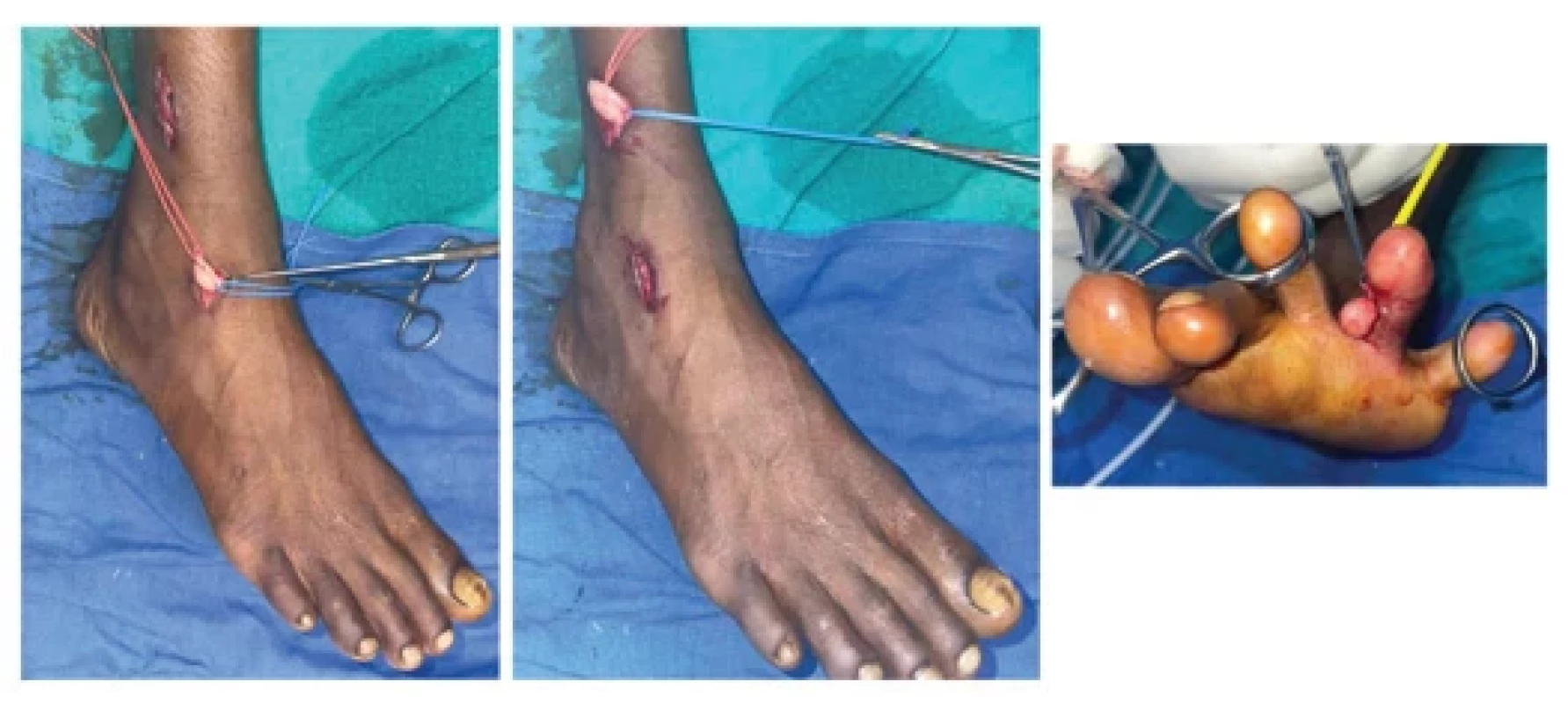 Schwannoma arising from multiple cutaneous nerves of the right distal leg and foot and digital nerve of the left fourth toe of the same patient. All tumors were excised with preservation of the nerve.