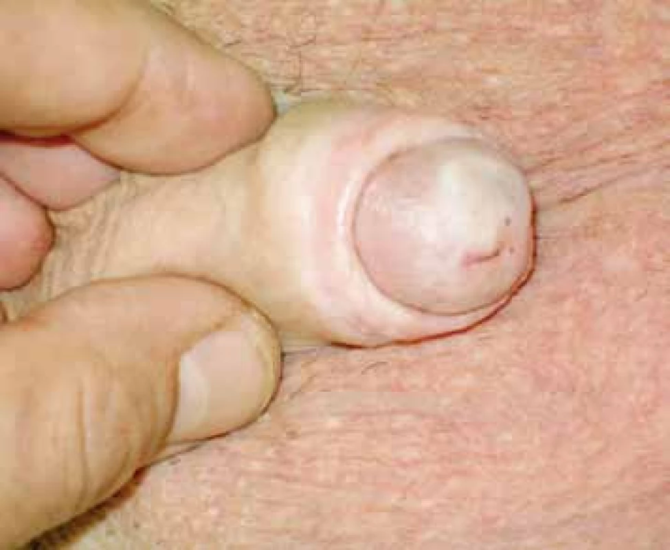 Typický klinický obraz BXO 
Fig. 1. BXO typical clinical presentation