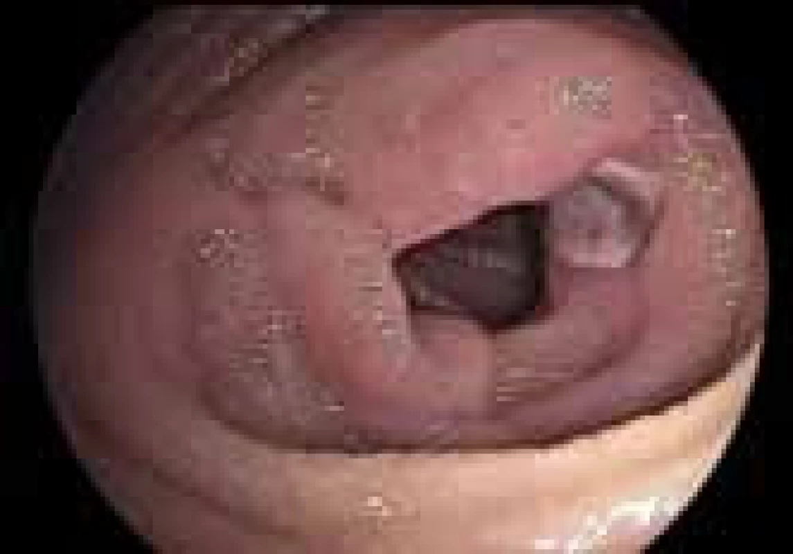 Ulcerace tenkého střeva – DBS endoskopie (ii. interní gastroenterologická klinika, Fn Hradec Králové).
Fig. 3. Ulceration of small intestine – DBS endoskopy (II. internal gastroenterology clinic, Faculty hospital Hradec Kralove).