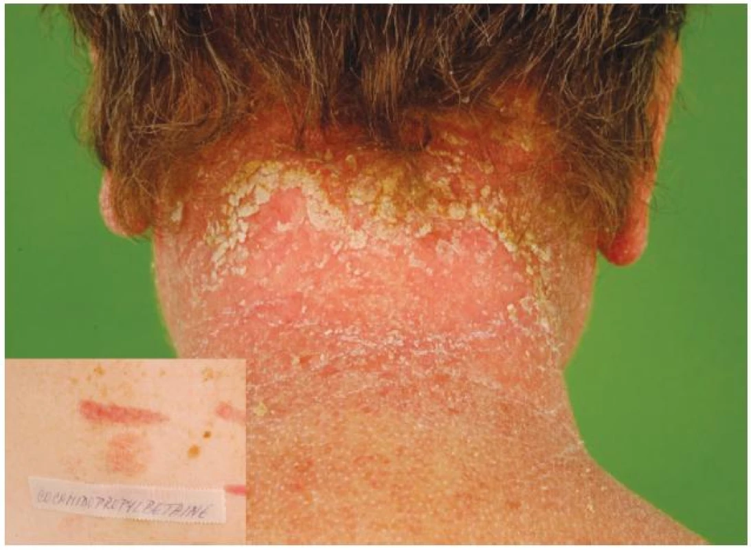 a) Eczema contactum – kokamidopropylbetain (šampony)
b) Epikutánní test – alergická reakce na kokamidopropylbetain