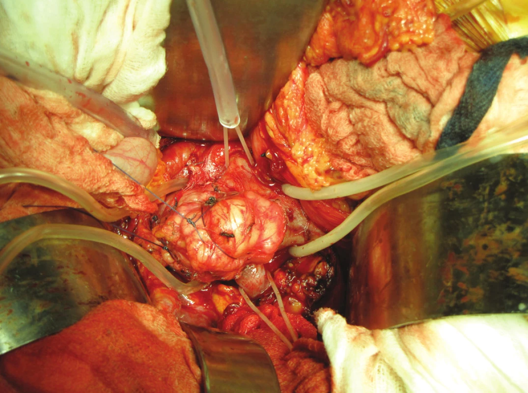 Tumor stěny v. cava in situ
Pic. 2. Tumor in situ in the wall v. cava inf