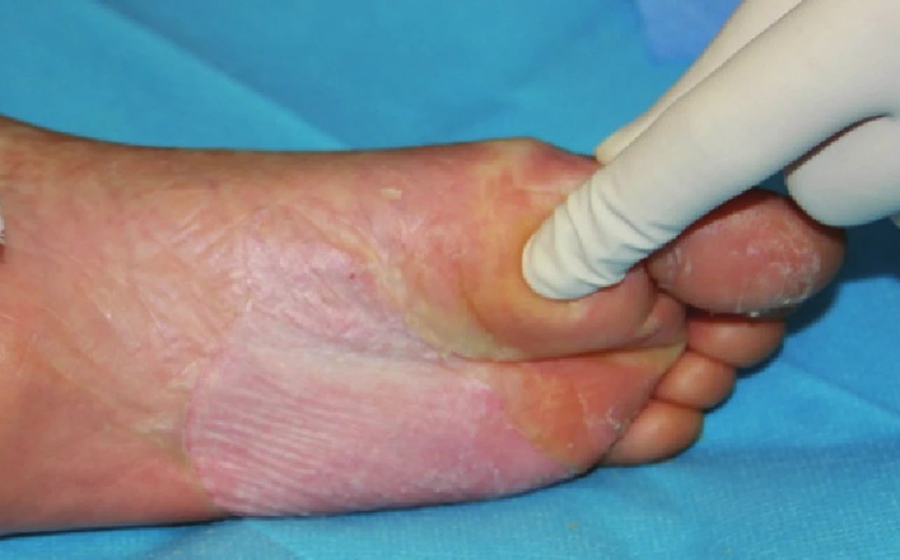 Zhojené plochy po xenotransplantaci na plosce levé nohy
Fig. 7: Healed areas following xenotransplantation on the sole of the left foot