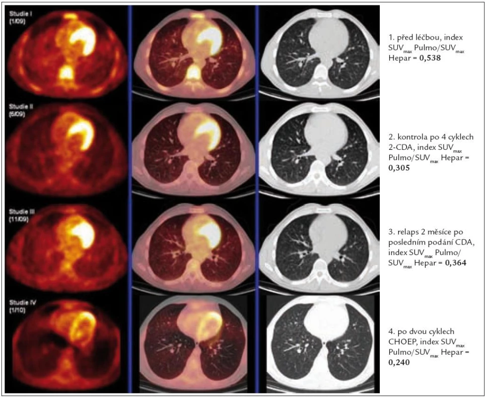 Korelace PET-CT plic, HRCT plic a indexu SUV Pulmo<sub>max</sub>/SUV Hepar<sub>max</sub> před léčbou, po 4 cyklech léčby 2-chlorodeoxyadenosinem, dále v době relapsu nemoci a po dvou cyklech léčby relapsu režimem CHOEP (cyklofosfamid, etoposid, adriamycin, vinkristin a prednison).