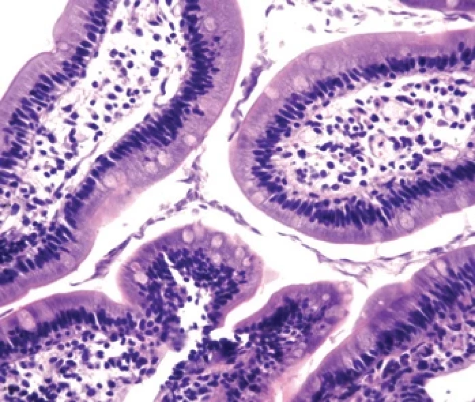 Biopsie duodena u pacienta s CVID. Mezi klky jsou četné struktury Giardia lamblia a ve stromatu klků chybí populace plazmocytů. Barvení: hematoxylin-eozin, zvětšení 400×. Fig. 􀍷. Duodenal biopsy in a patient with CVID. Numerous Giardia lamblia structures are present between the villi, and there is an absence of plasma cell populations in the villi stroma. Staining: hematoxylin-eosin, magnifi cation 400×.