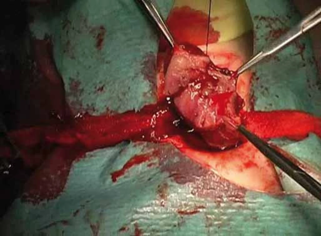 Excision of thyroid nodule.
