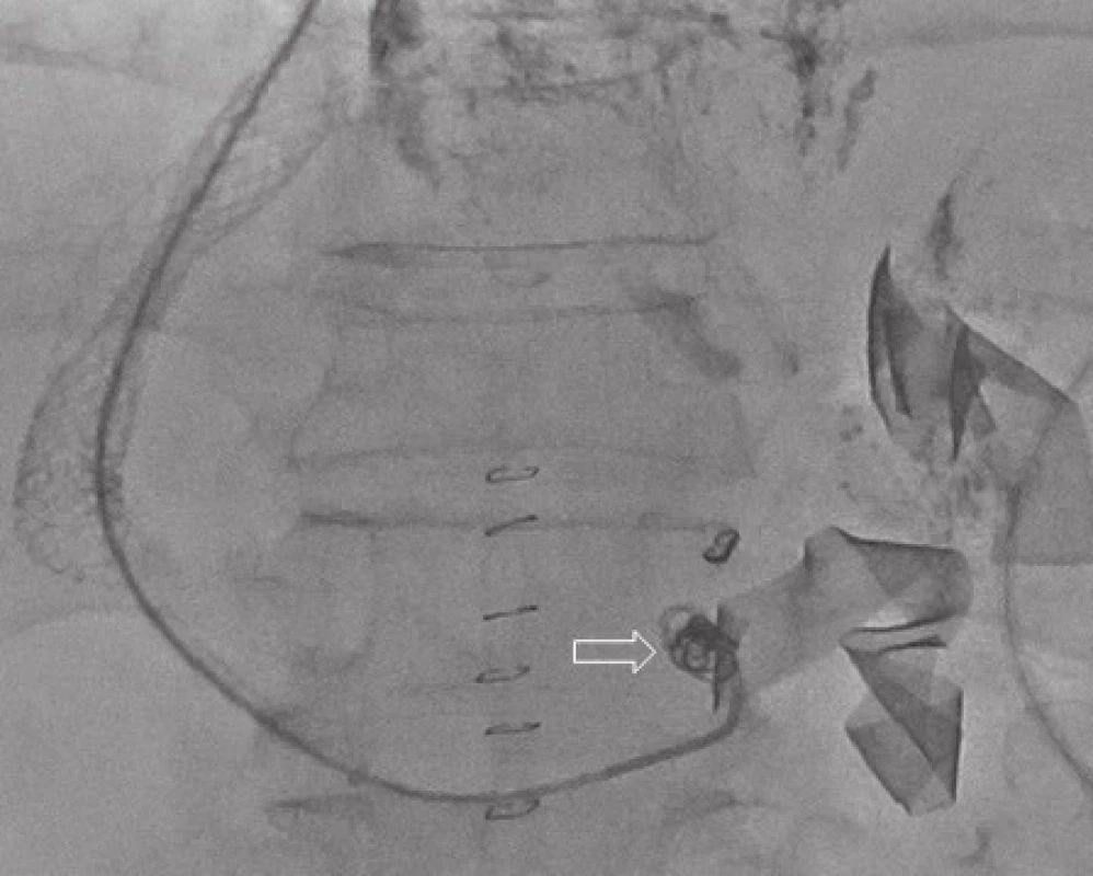 Embolizace varikozit koily a histoakrylátovvým lepidlem (portografie)
Fig. 2: Variceal embolisation with coils and histoacrylic glue (Portography)