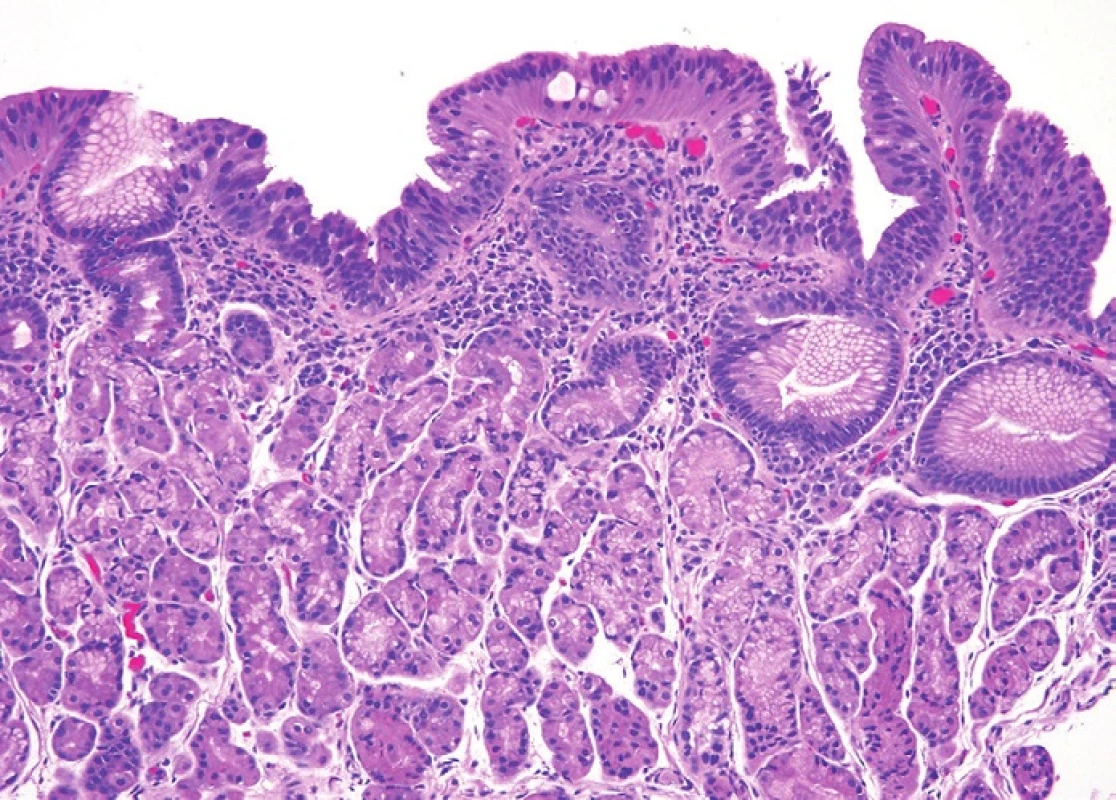 Lateral (surface) spread over the columnar epithelial surface. In this image, the surface shows dysplastic epithelium with loss of nuclear polarity and nuclear rounding that characterize high-grade intestinal type dysplasia but the lesion sits atop oxyntic mucosa. Adjoining biopsies showed more classic highgrade dysplasia. Such lesions are often seen at the edge of invasive carcinomas that spread into the cardia region. H&amp;E (100x).