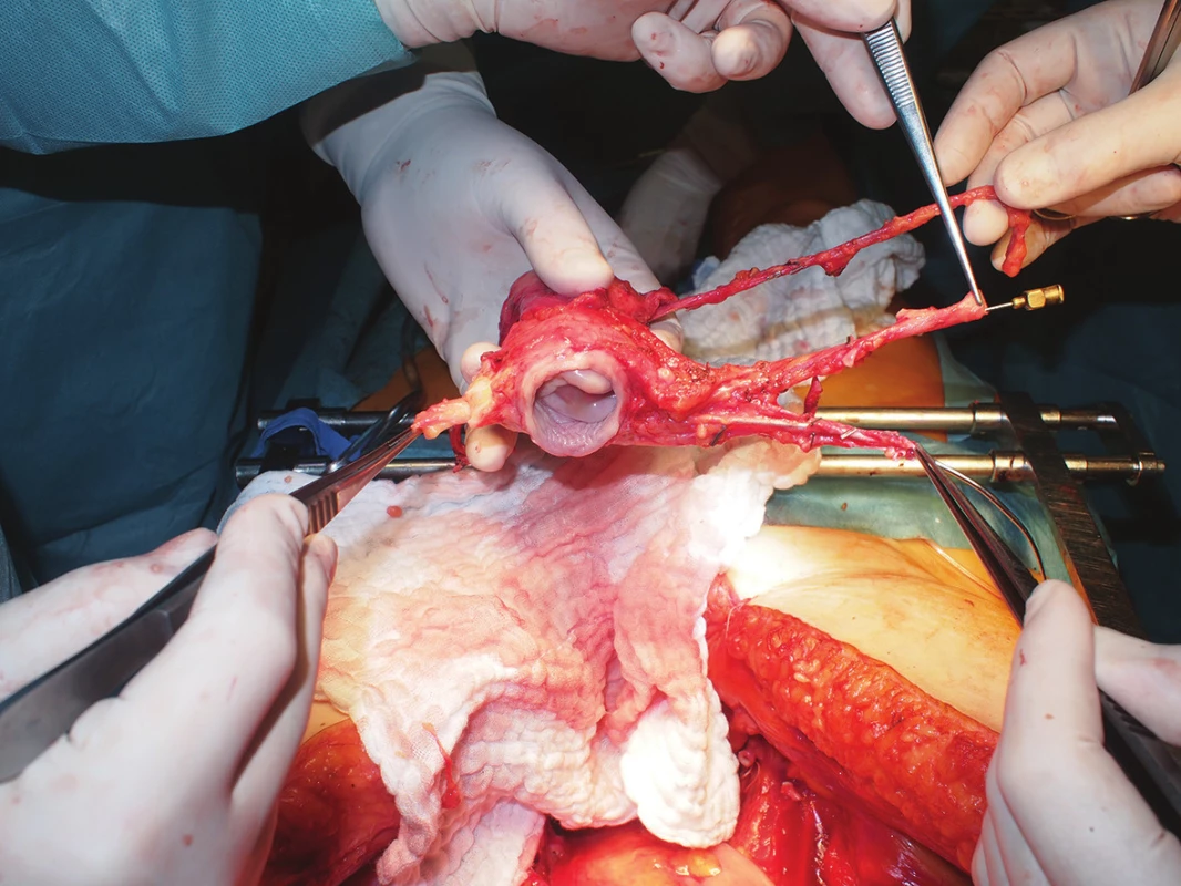 Deceased donor uterus graft quality assessment, including related vasculature