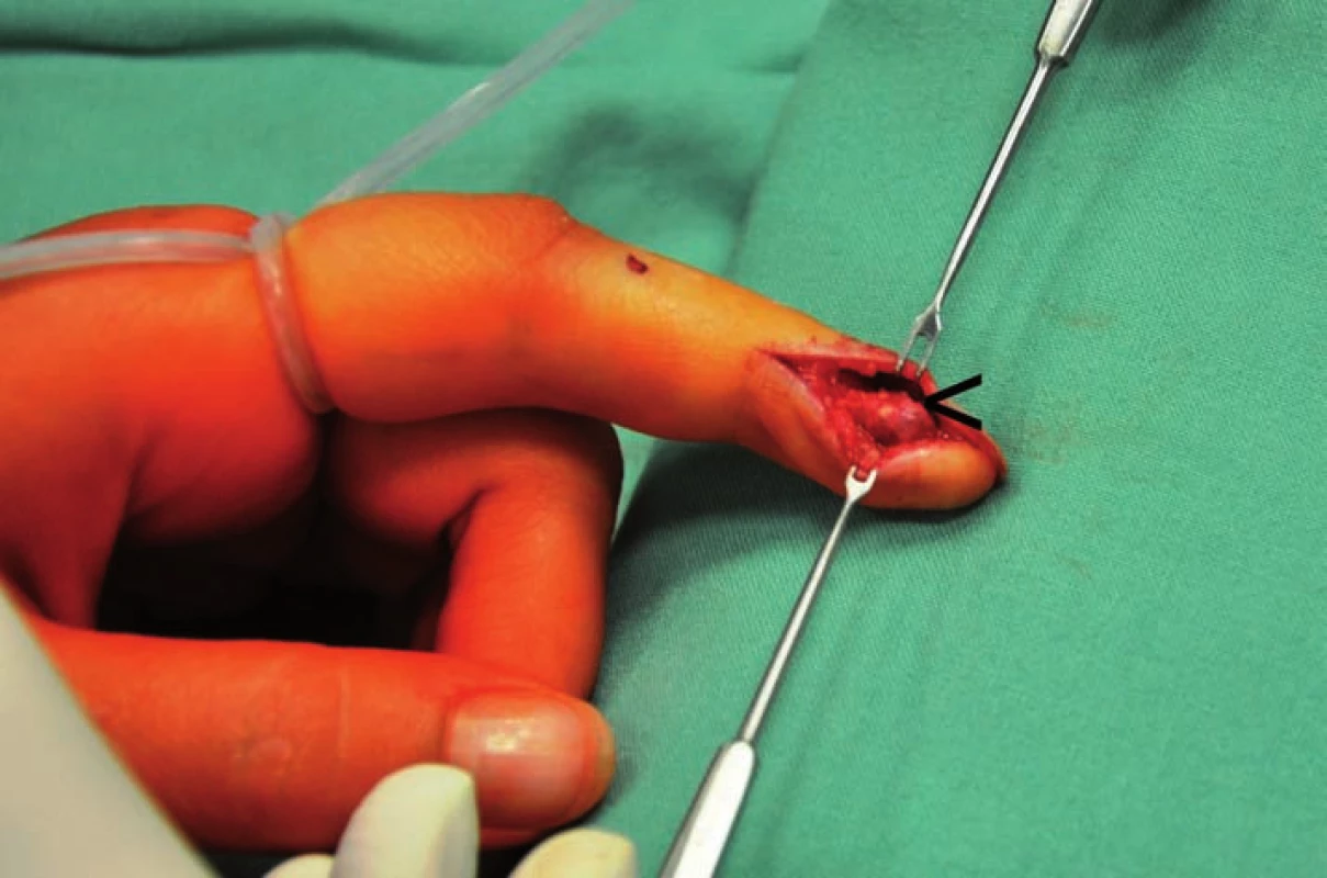 Peroperační snímek. Laterální střední incize, v ráně viditelný glomus tumor – označen šipkou