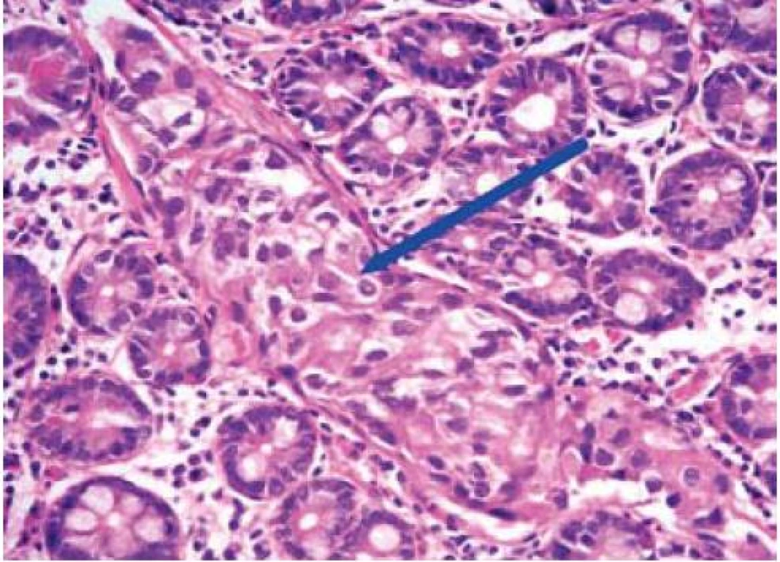 Lymfagioinvaze – struktury karcinomu patrné uvnitř lymfatické cévy – viz šipka.
Fig. 2. Lymphatic vessel invaded by carcinoma – see arrow.