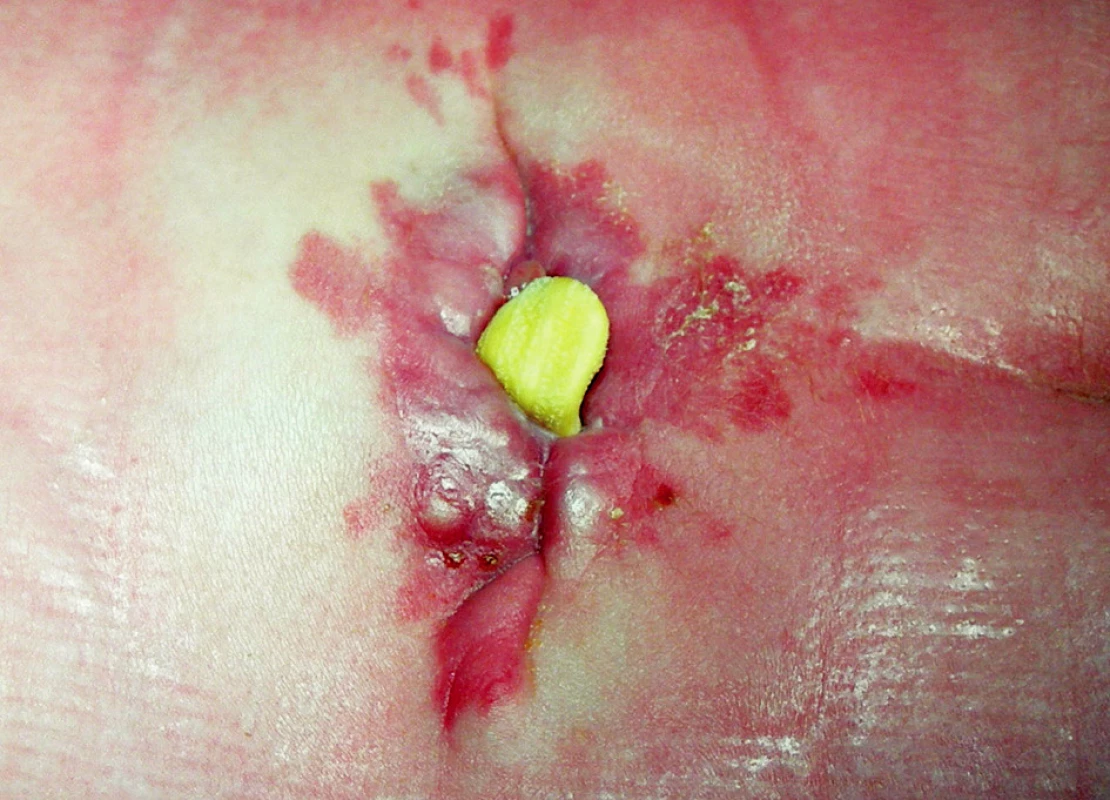 Detail operačnej rany s dehiscenciou a sekvestráciou syntetického materiálu
Fig. 2. Operation wound detail with dehiscency and sequestration of synthetic material
