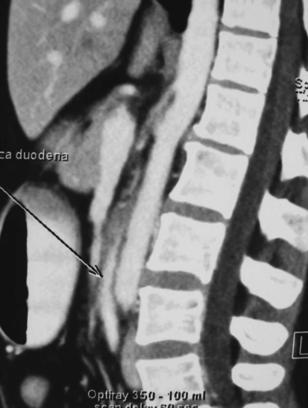 CT scan v sagitálnej rovine. Zobrazuje kompresiu duodena medzi AA a AMS. Vidieť ostrý uhol odstupu AMS z AA
Fig. 4. CT scan, sagittal plane. Compression of the duodenum between the AA and SMA (AMS) is apparent, as well as the closed angle of the SMA(AMS) branching off the AA