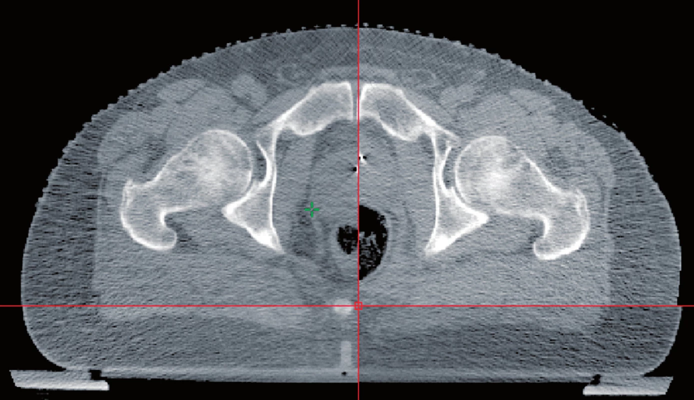 Vliv náplně rekta na uložení prostaty
Fig. 3. The influence of the rectal fullness on the position of the prostate
