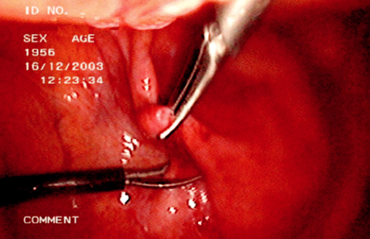 Laparoskopická fenestrace lymfokély
Fig. 3. Laparoscopic fenestation of the lymphocele