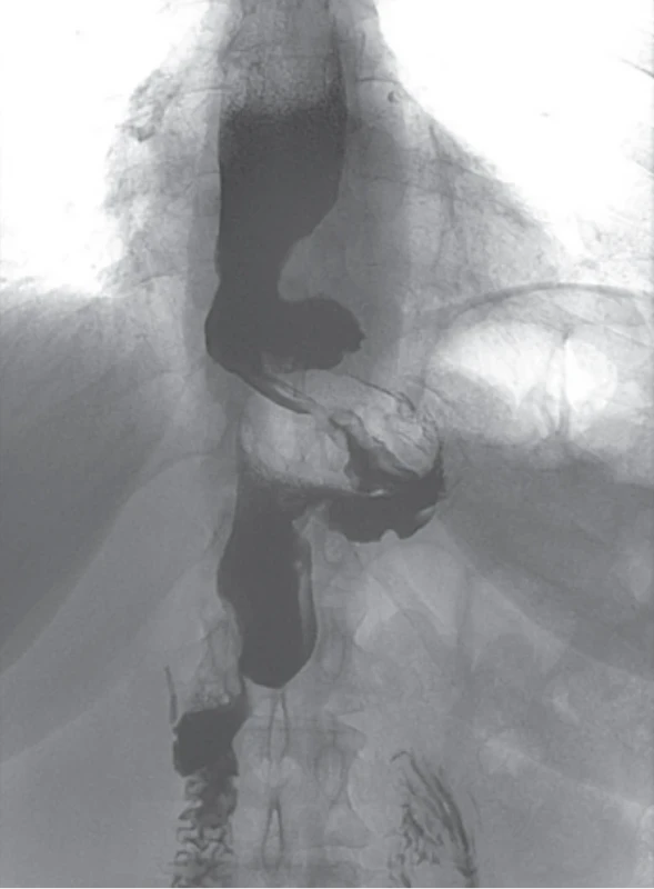 Skiagrafické vyšetření jícnu a žaludku s perorálně podanou kontrastní látkou. Fig. 1. Skiagraphic examination of the esophagus and stomach using an orally administered contrast agent.