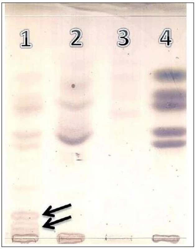 Tenkovrstvová chromatografia (TLC) oligosacharidov moča. Dráha 1: pacient – GM1 gangliozidóza, dráha 2 a 3: normálny profil oligosacharidov v moči, dráha 4: referenčná – štandardy (od vrchu dole), xylóza/glukóza/galaktóza/laktóza/rafinóza. Abnormálne frakcie oligosacharidov typické pre GM1 gangliozidózu sú indikované šípkou.
Fig. 3. Thin-layer chromatography (TLC) of urinary oligosaccharides:
Track 1: patient – GM1 gangliosidosis, tract 2 and 3: normal profile of oligosaccharides in urine, track 4: reference standards (from top to bottom), xylose/glucose/galactose/lactose/raffinose. Abnormal fractions of oligosaccharides typical for GM1 gangliosidosis are indicated by arrow.