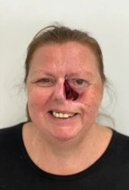 Defect of the anterior wall of maxilla and a partial defect of the inferior and medial orbital wall on the right 2 years after ablative surgery due to squamous cell carcinoma.
