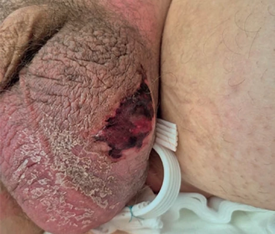  Nekróza kůže skrota po drenáži perianálního abscesu  s progresí do Fournierovy ganrény.  Scrotal skin necrosis after drainage of perianal abscess with  progression to Fournier's gangrene.