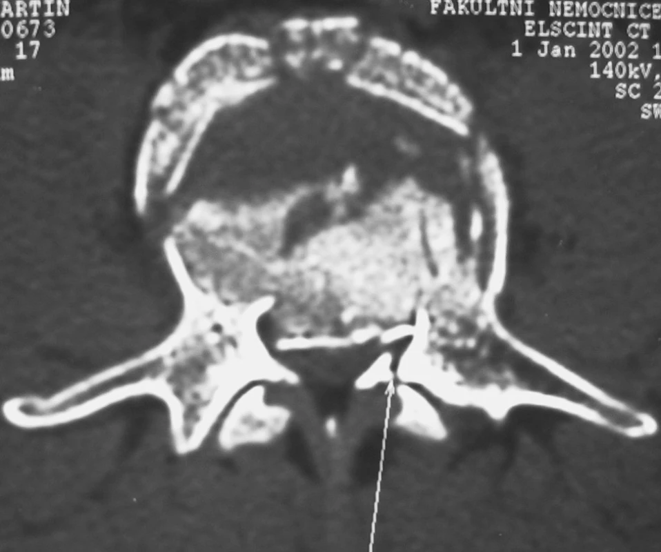Axiální CT řez pincer burst zlomeniny obratlového těla typ A2.3
Pic. 2. Axial CT view of the pincer burst vertebral body fracture, type A2.3