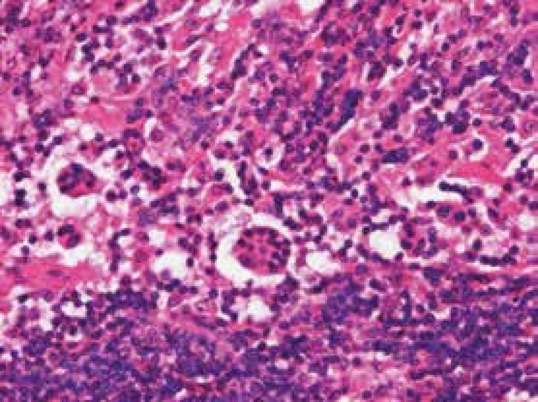 Zřetelná tzv. emperipoléza: přítomnost intaktních lymfocytů v cytoplazmě sinusových histiocytů. Histologický preparát, barvení hematoxylin-eozin, zvětšení 200krát