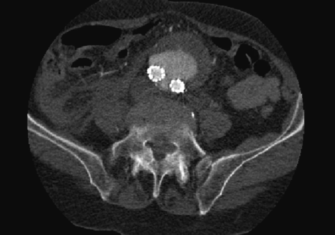 CTA obraz masivního endoleaku
Fig. 6: CTA image of a massive endoleak
