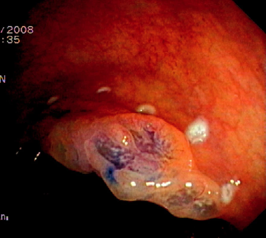 Plochá léze typu 0IIa+IIc rozměrů 30x20 mm v kolon ascendens. Chromodiagnostika 0,2% roztokem indigokarmínu a označení okraje kogulačními body
Pic. 1. Flat neoplastic lesion type 0IIa+IIc, size 30x20mm in the ascending colon. Chromodiagnosis with 0.2% indigocarmine solution and marking of the border with coagulation spots
