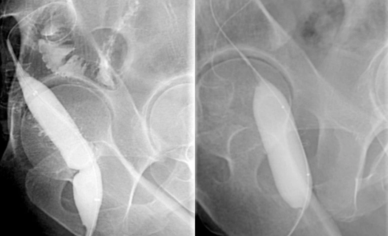 Balonková dilatace striktury kolorektální anastomózy
Fig. 1. Balloon dilatation of the stricture of the colorectal anasomosis