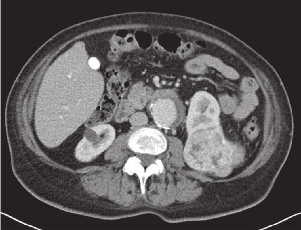 Aneuryzma břišní aorty a renální karcinom dolní poloviny levé ledviny
Fig. 1: Abdominal aortic aneurysm and renal carcinoma of the lower half of the left kidney