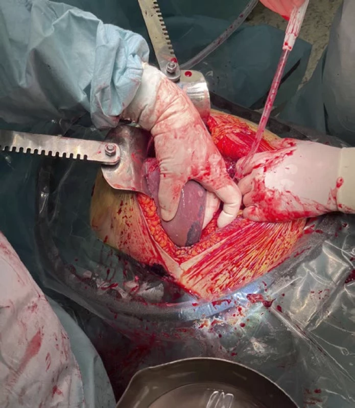 CT snímek – subkostální řez. Foto z první operační revize jaterního parenchymu (2. operace; trhliny nejsou přístupné fotoaparátu, zobrazeny pouze hematomy).