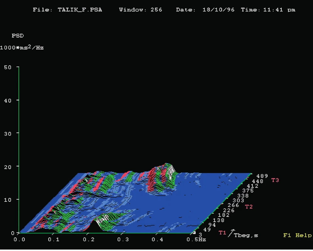 Ukázka 3D záznamu spektrální analýzy variability srdeční frekvence pacienta - kardiaka 
po bypassu.