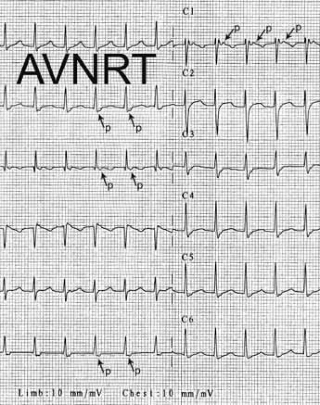 Atrioventrikulární nodální reentry tachykardie (AVNRT). Šipky ukazují na negativní morfologii P-vln těsně za QRS komplexem ve svodech II, III, VF, což potvrzuje diagnózu typické AVNRT. Začátek P vln je dobře patrný < 80 ms za začátkem QRS-komplexu v 1. hrudním svodu – C1.