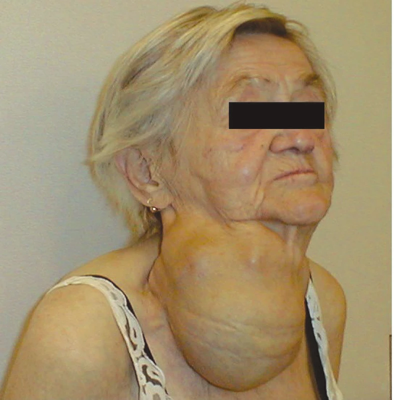 80ti letá nemocná s endemickou polynodózní strumou
Fig. 1: 80 years old female with an endemic multinodular goiter